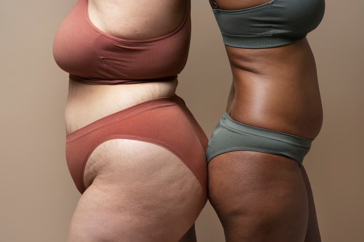 Lipedema x celulite: entenda as diferenças