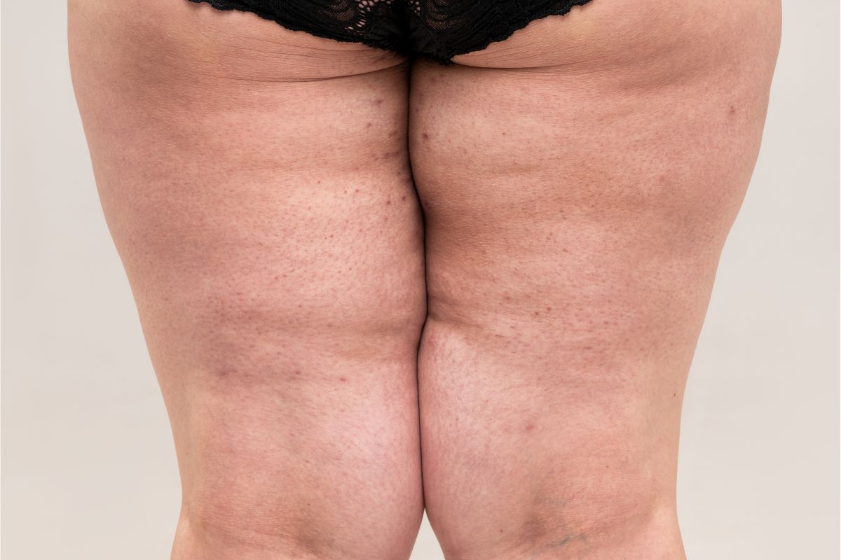 sinais do lipedema