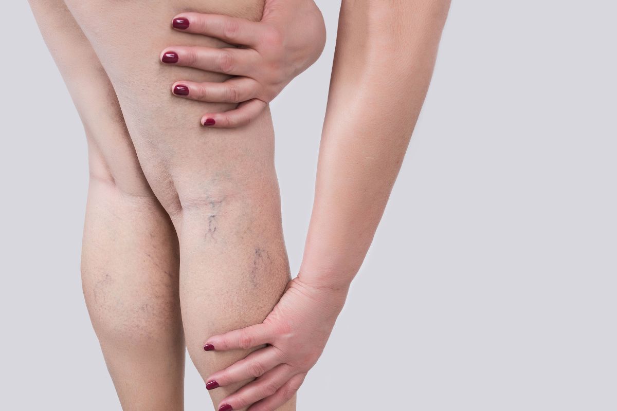 lipedema e hipermobilidade articular